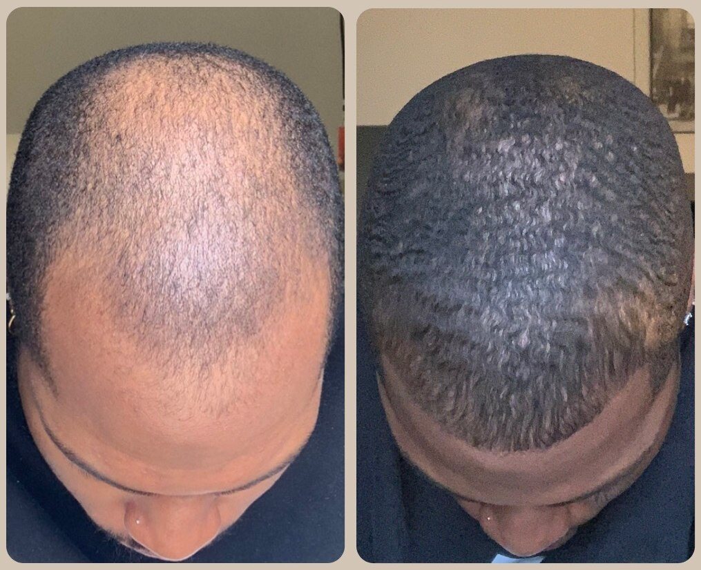 Crown regrowth, before and after