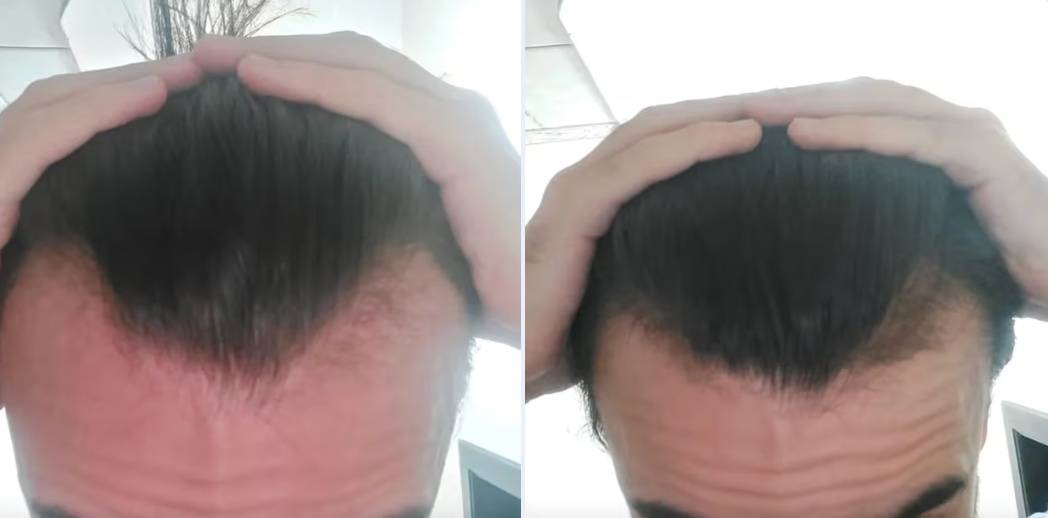 Customer top-of-head comparison showing density change