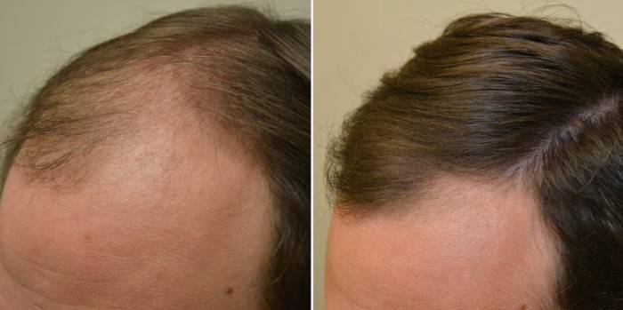 Reader hair-progress comparison photo