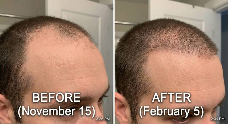 Customer hairline comparison before and after